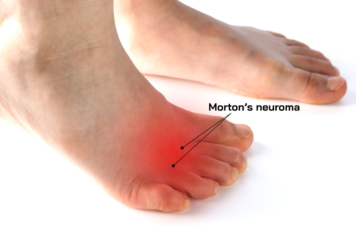 Neuroma di Morton