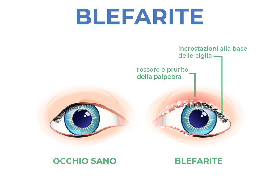 blefarite sintomi